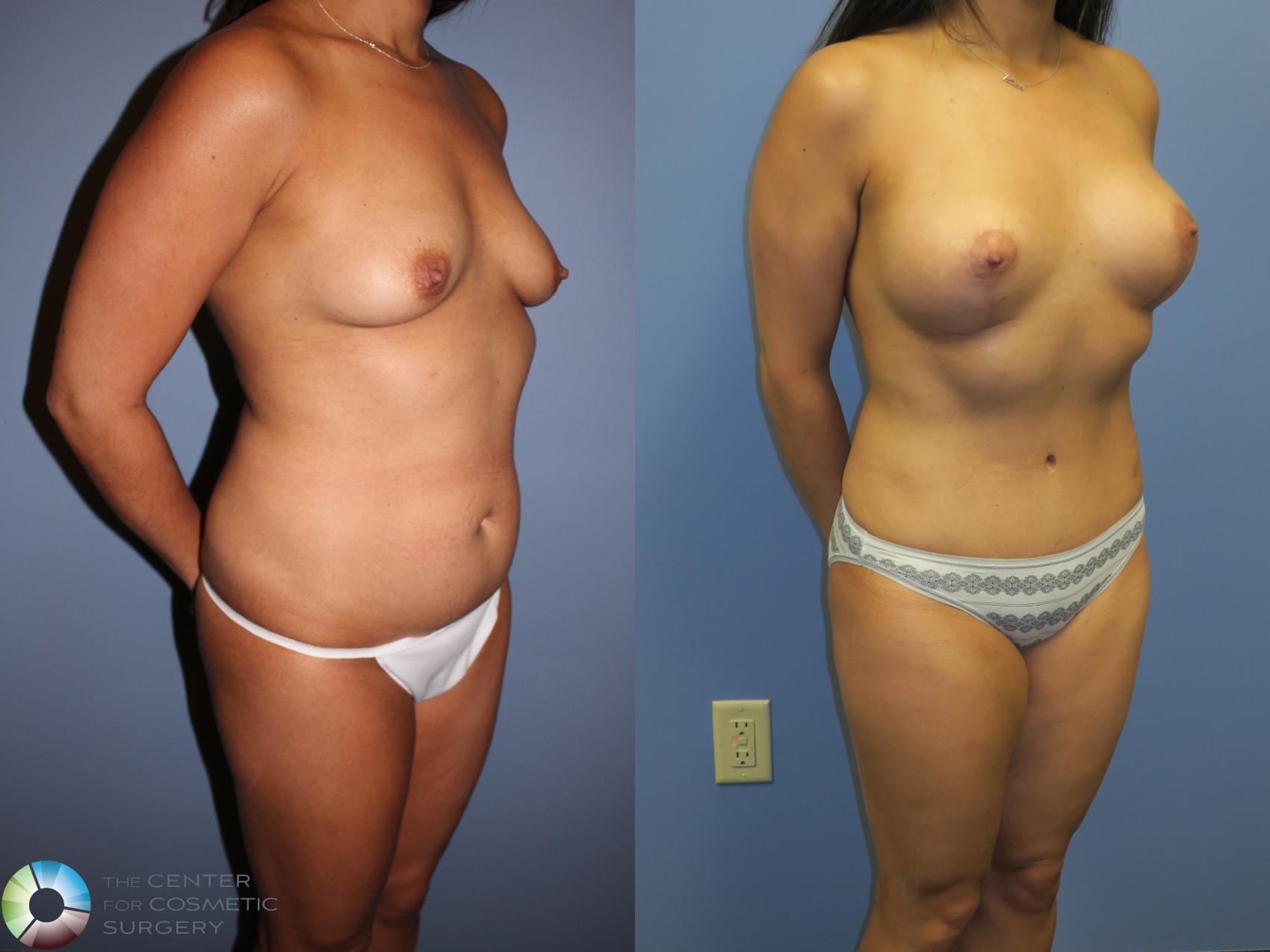 Before & After Mommy Makeover Case 11358 Right Oblique View in Golden, CO