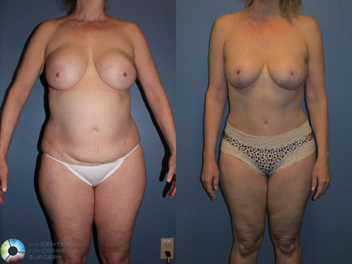 Before & After Mommy Makeover Case 11359 Front View in Golden, CO