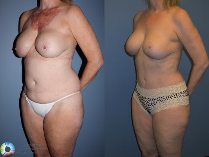 Before & After Mommy Makeover Case 11359 Left Oblique View in Golden, CO