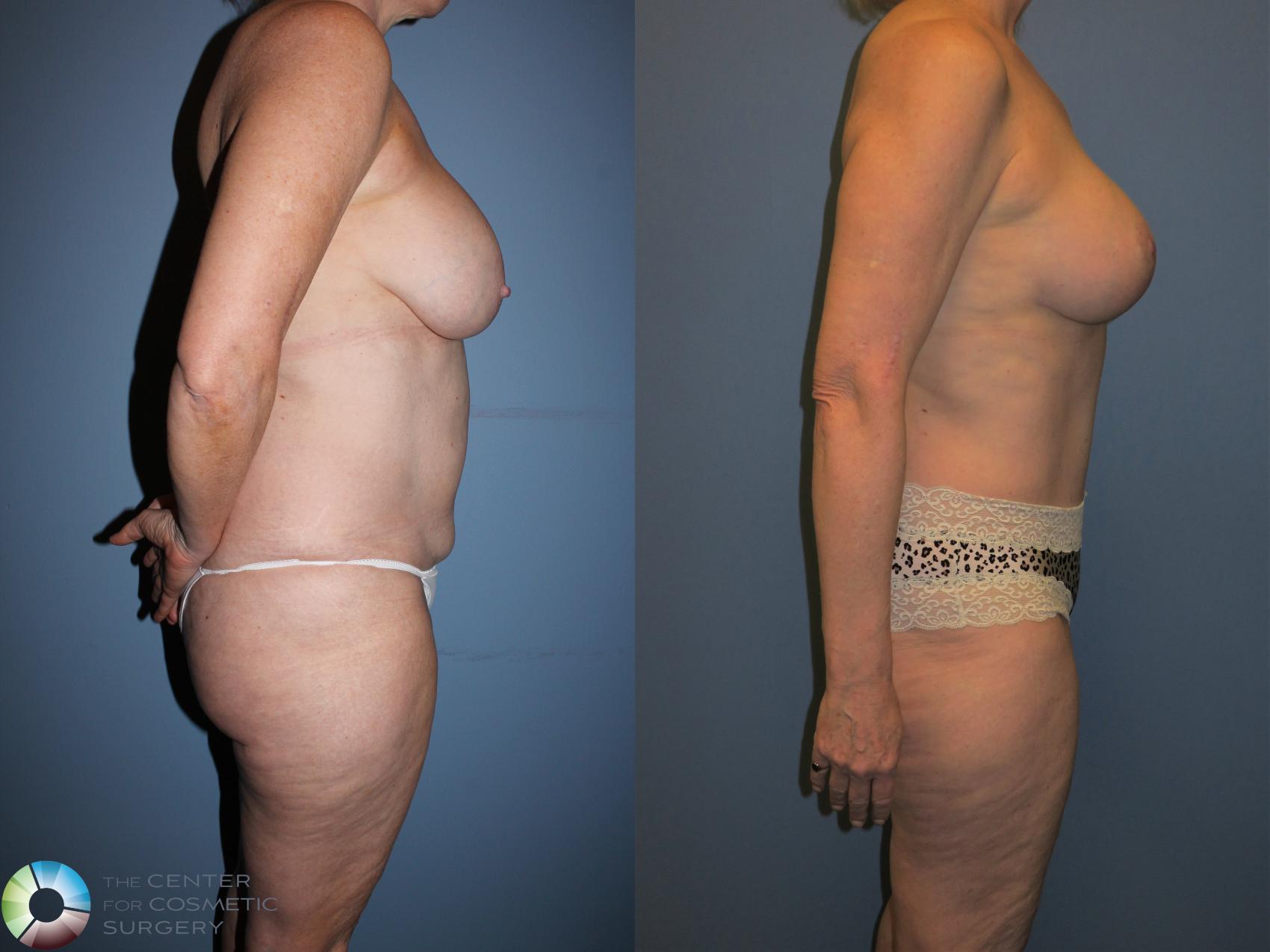 Before & After Mommy Makeover Case 11359 Right Side View in Golden, CO