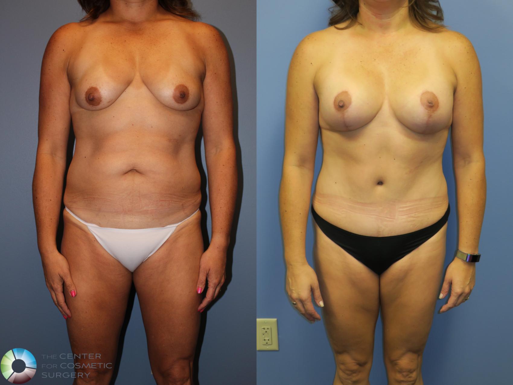 Before & After Mommy Makeover Case 11360 Front View in Golden, CO
