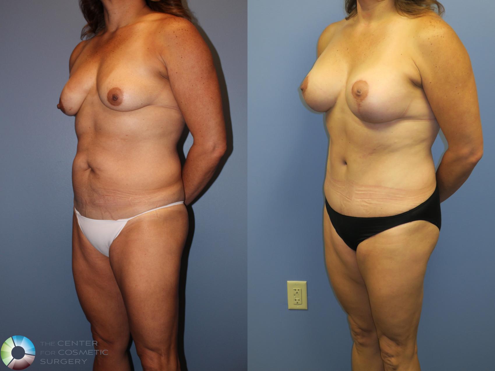 Before & After Mommy Makeover Case 11360 Left Oblique in Denver and Colorado Springs, CO