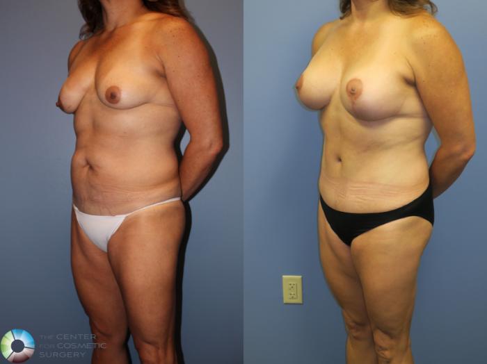 Before & After Breast Lift Case 11360 Left Oblique View in Golden, CO