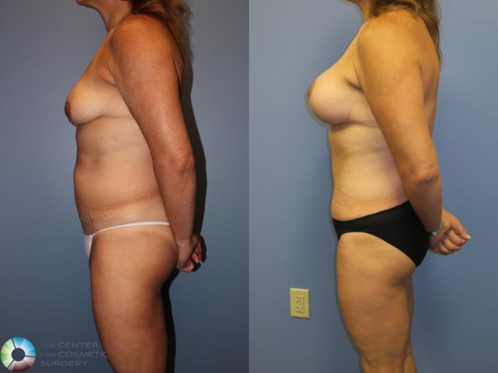 Before & After Breast Lift Case 11360 Left Side View in Golden, CO