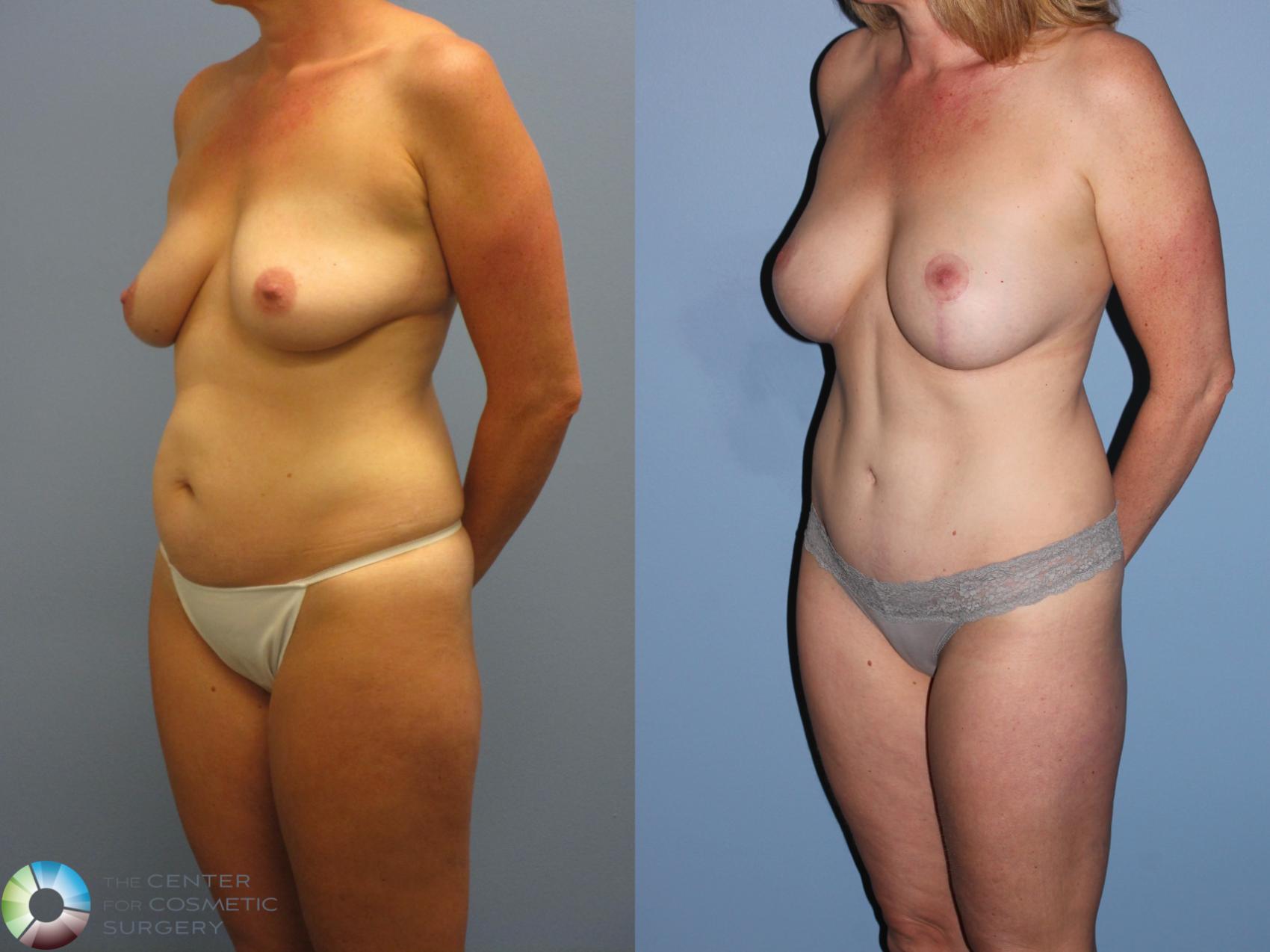 Before & After Breast Lift Case 11362 Left Oblique View in Golden, CO