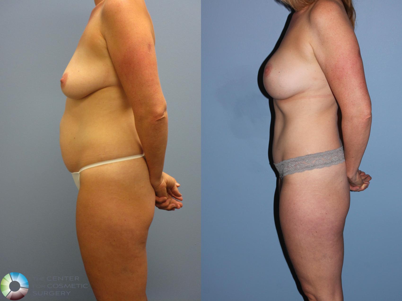 Before & After Mommy Makeover Case 11362 Left Side in Denver and Colorado Springs, CO