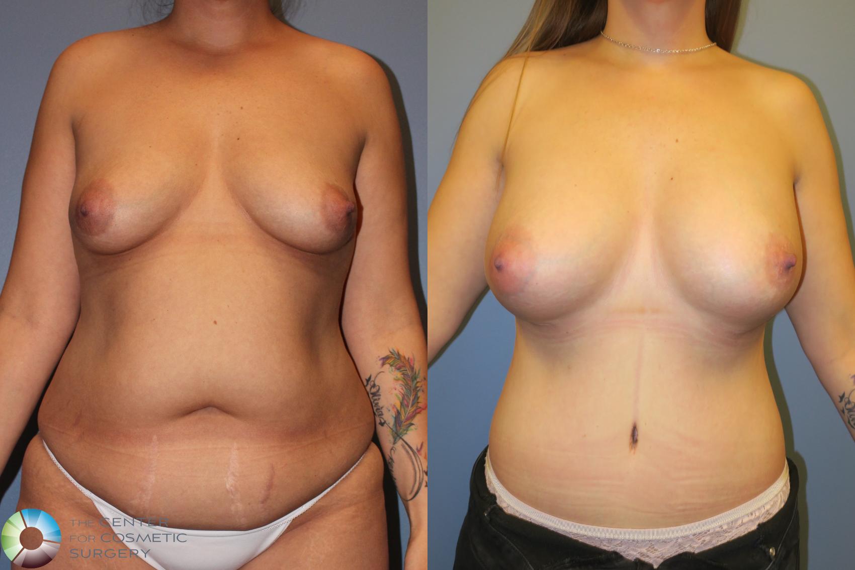 Before & After Mommy Makeover Case 11363 Front in Denver and Colorado Springs, CO