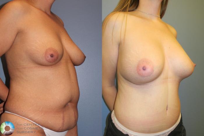 Before & After Mommy Makeover Case 11363 Right Oblique View in Golden, CO
