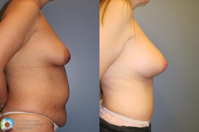 Before & After Mommy Makeover Case 11363 Right Side View in Golden, CO