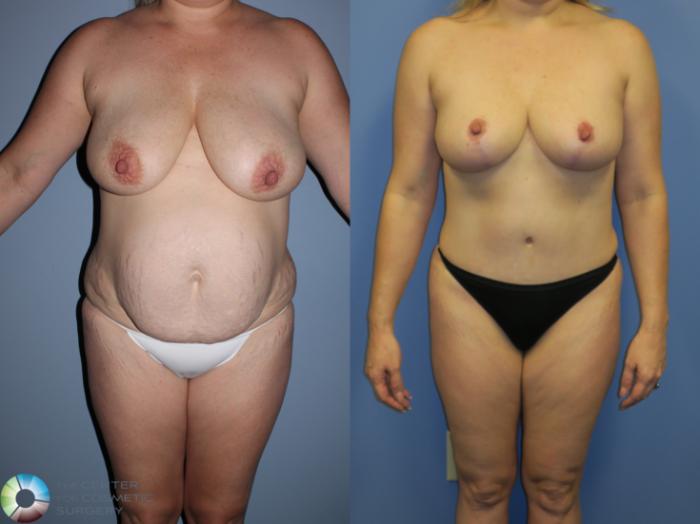 Before & After Tummy Tuck Case 11366 Front in Denver and Colorado Springs, CO