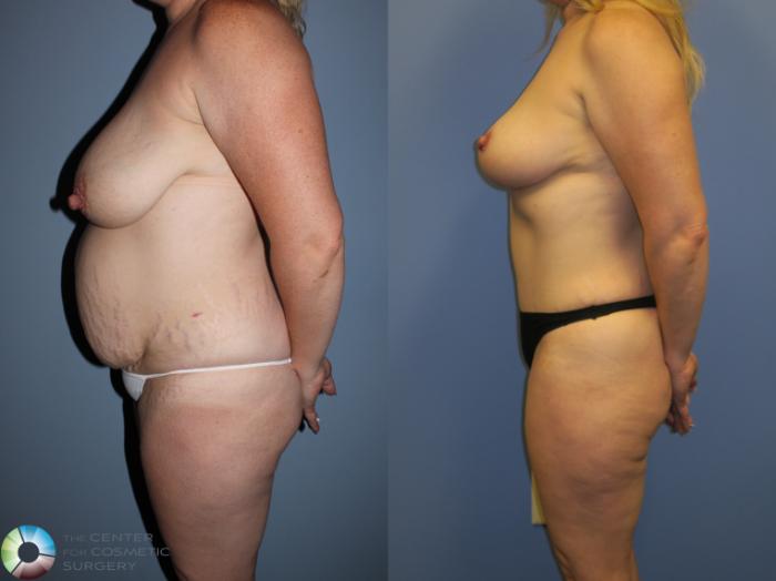 Before & After Breast Lift Case 11366 Left Side in Denver and Colorado Springs, CO