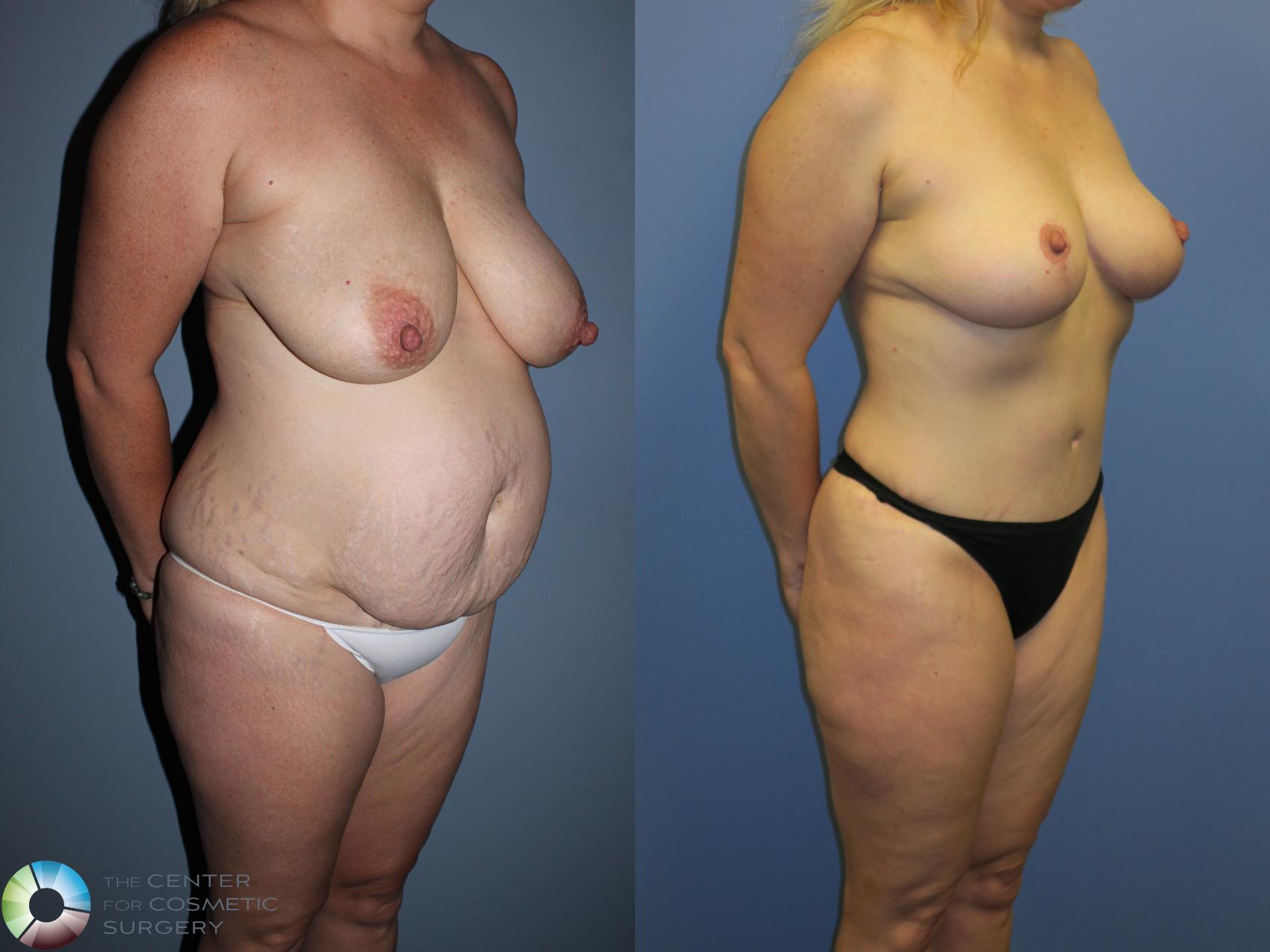 Before & After Mommy Makeover Case 11366 Right Oblique View in Denver & Golden, CO