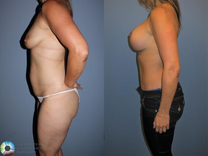 Before & After Breast Lift Case 11367 Left Side View in Golden, CO
