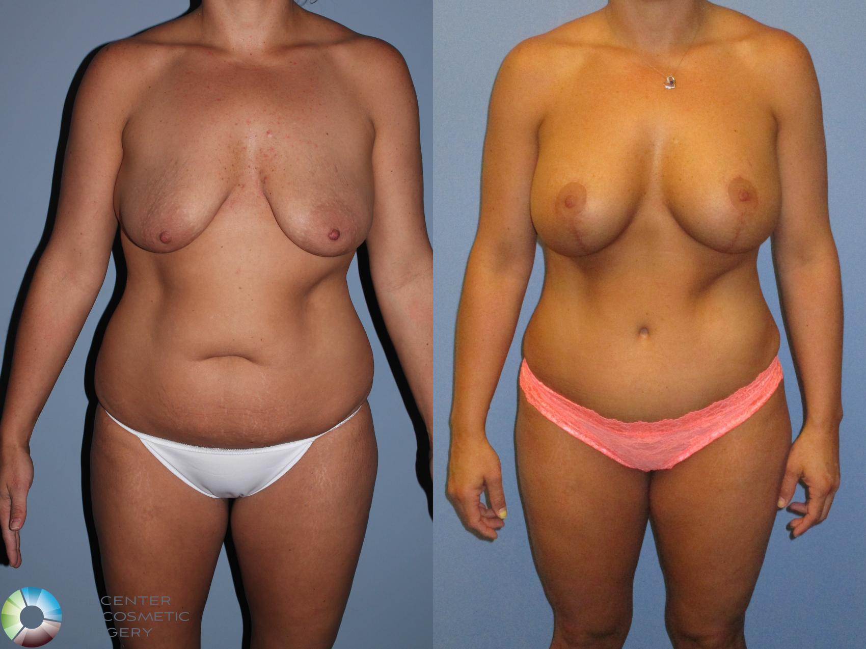 Before & After Breast Lift Case 11371 Front in Denver and Colorado Springs, CO