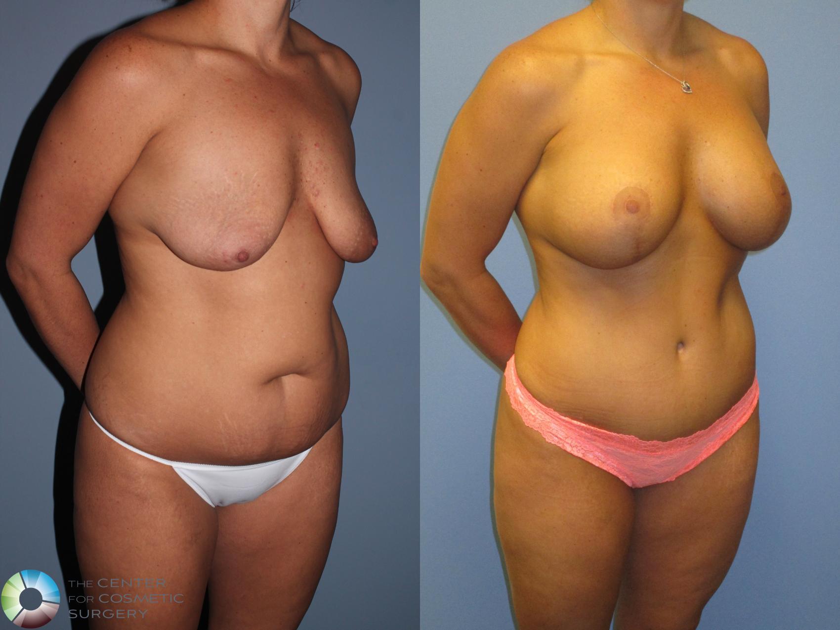 Before & After Mommy Makeover Case 11371 Right Oblique in Denver and Colorado Springs, CO