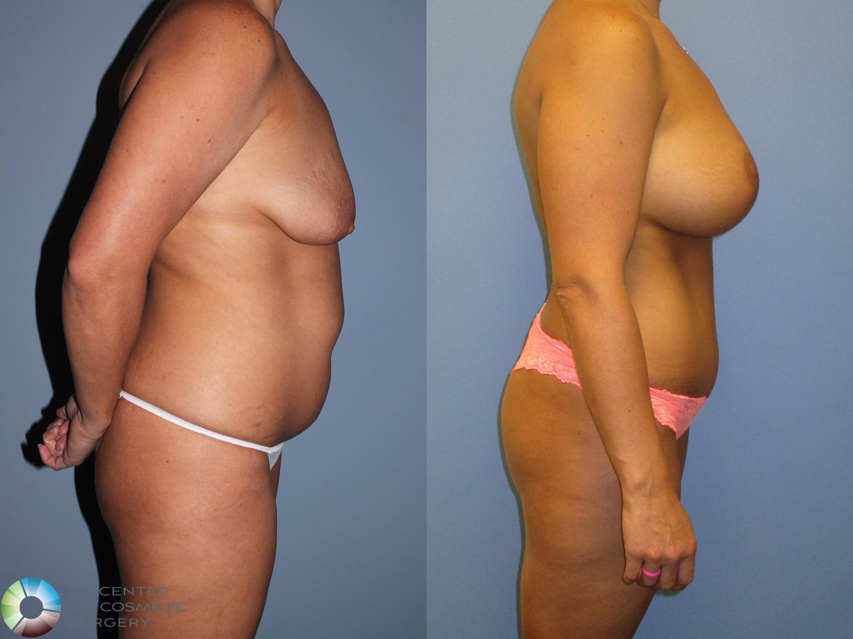 Before & After Mommy Makeover Case 11371 Right Side in Denver and Colorado Springs, CO