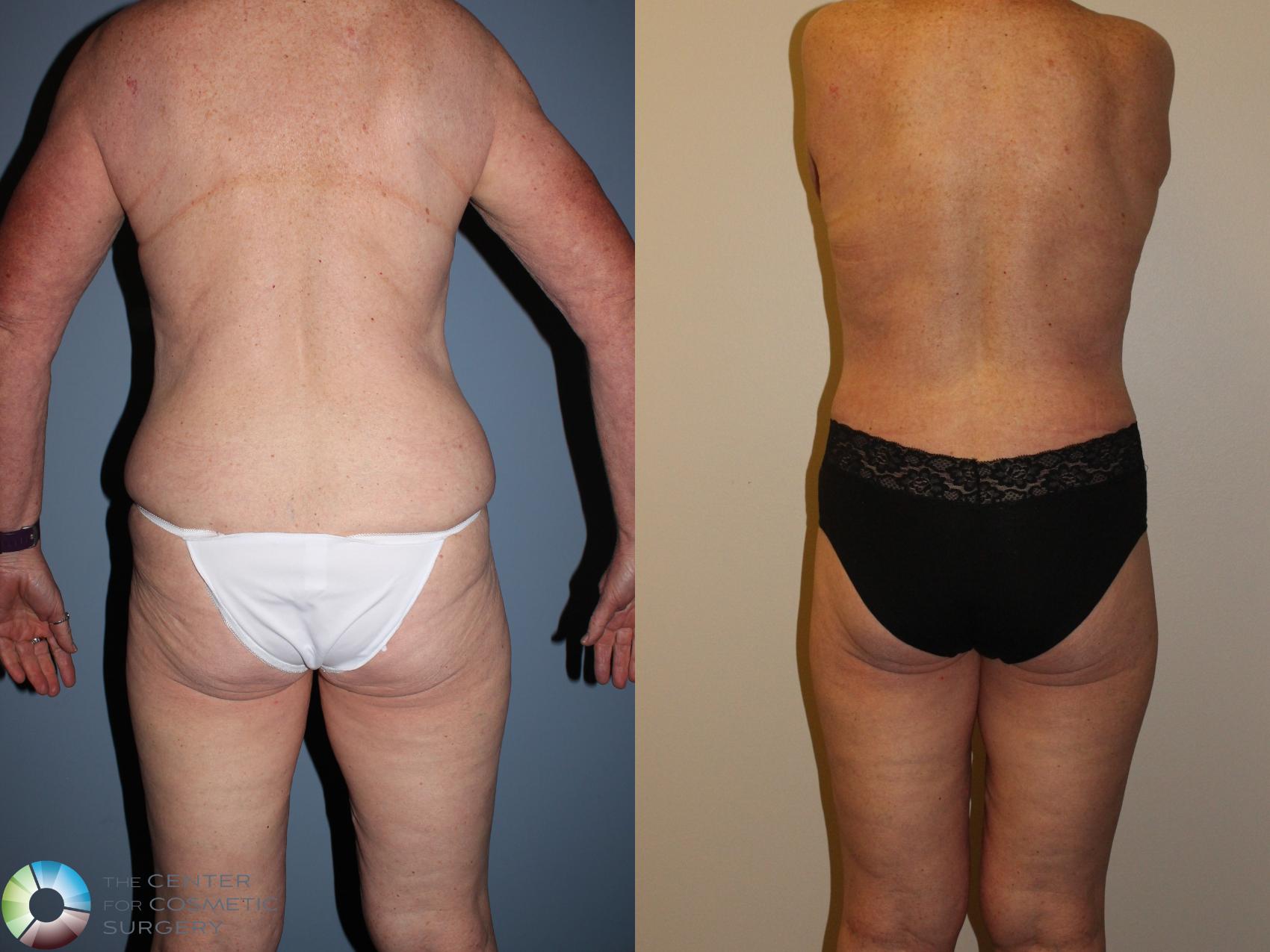 Before & After Body Lift Case 11374 Back View in Golden, CO