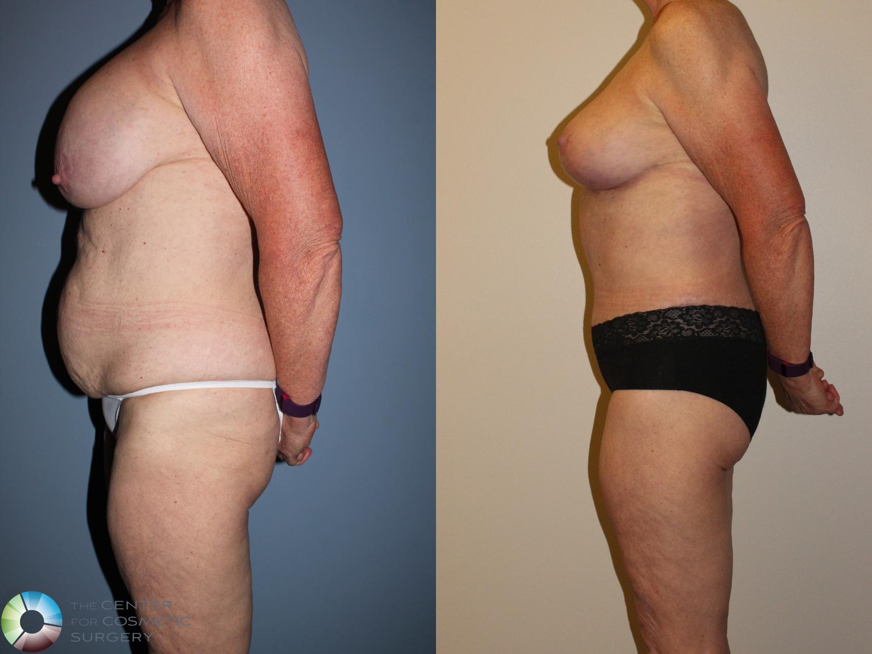 Before & After Body Lift Case 11374 Left Side View in Golden, CO