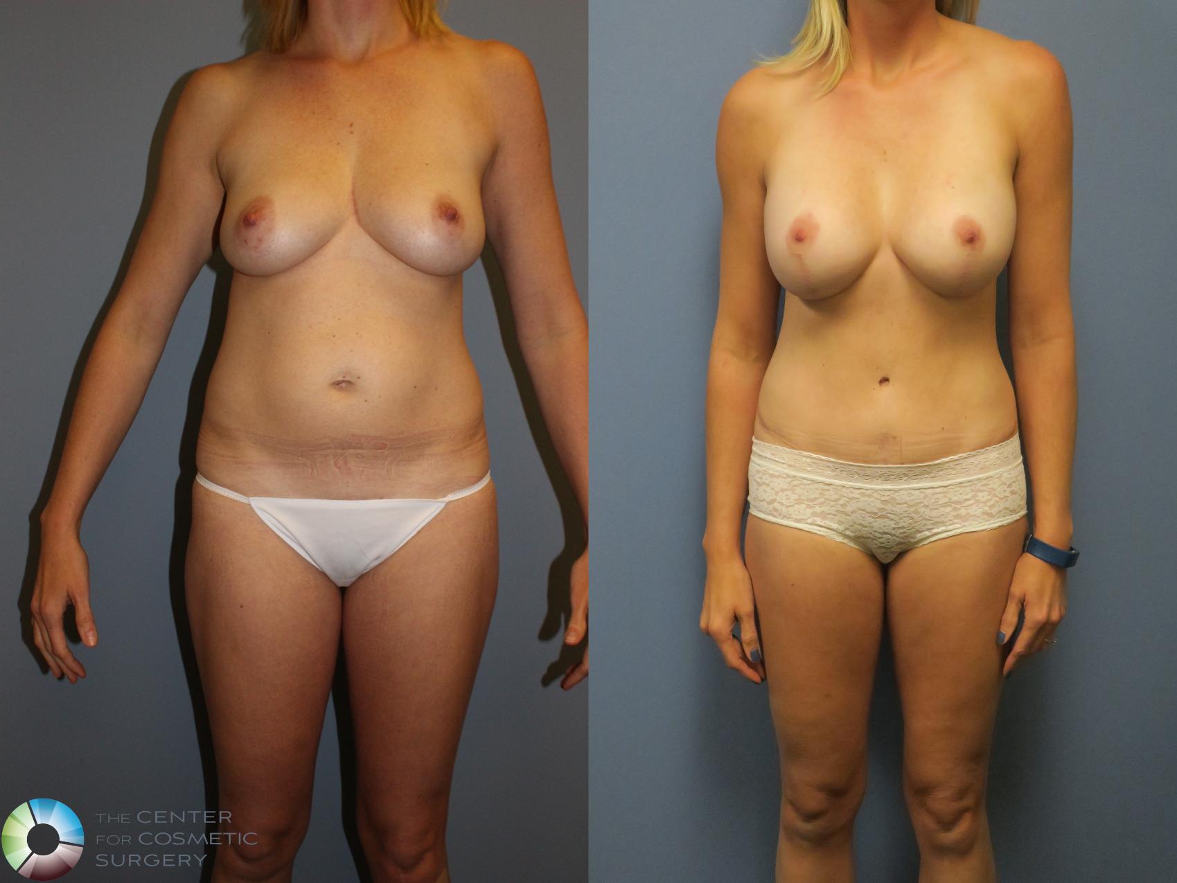 Before & After Mommy Makeover Case 11375 Front in Denver and Colorado Springs, CO