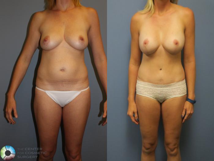 Before & After Tummy Tuck Case 11375 Front View in Golden, CO