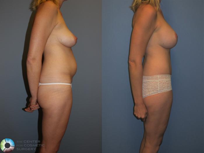Before & After Tummy Tuck Case 11375 Right Side View in Golden, CO
