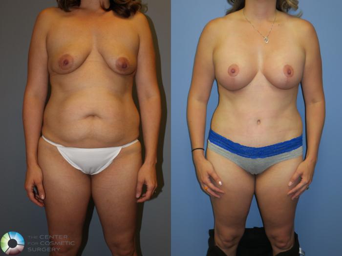 Before & After Tummy Tuck Case 11376 Front in Denver and Colorado Springs, CO