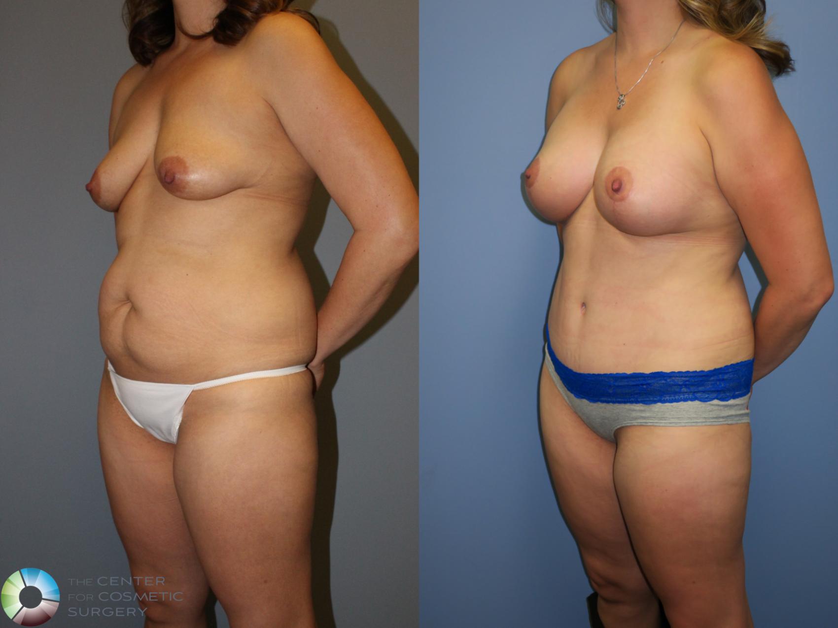 Before & After Mommy Makeover Case 11376 Left Oblique in Denver and Colorado Springs, CO