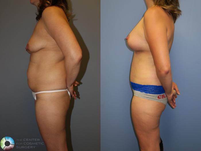 Before & After Tummy Tuck Case 11376 Left Side in Denver and Colorado Springs, CO
