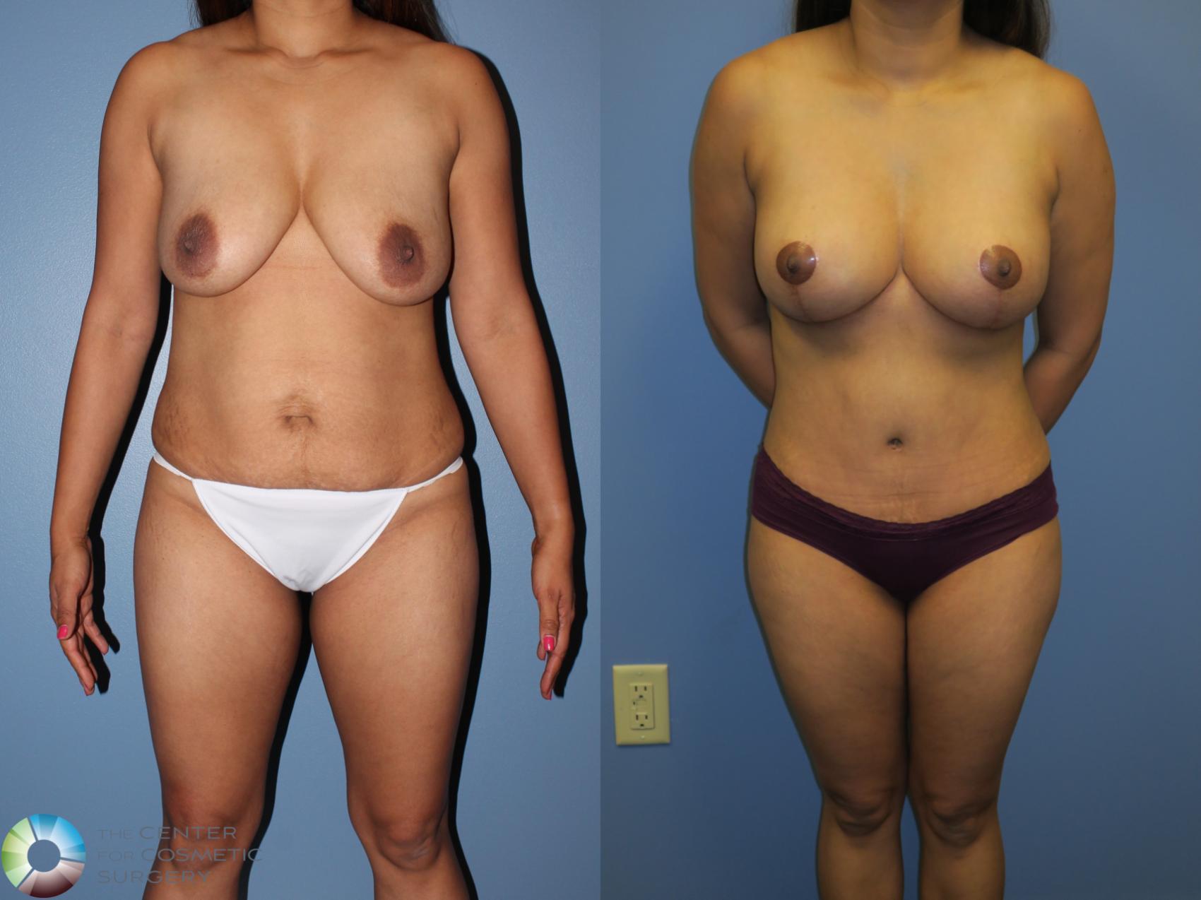 Before & After Mommy Makeover Case 11377 Front in Denver, CO