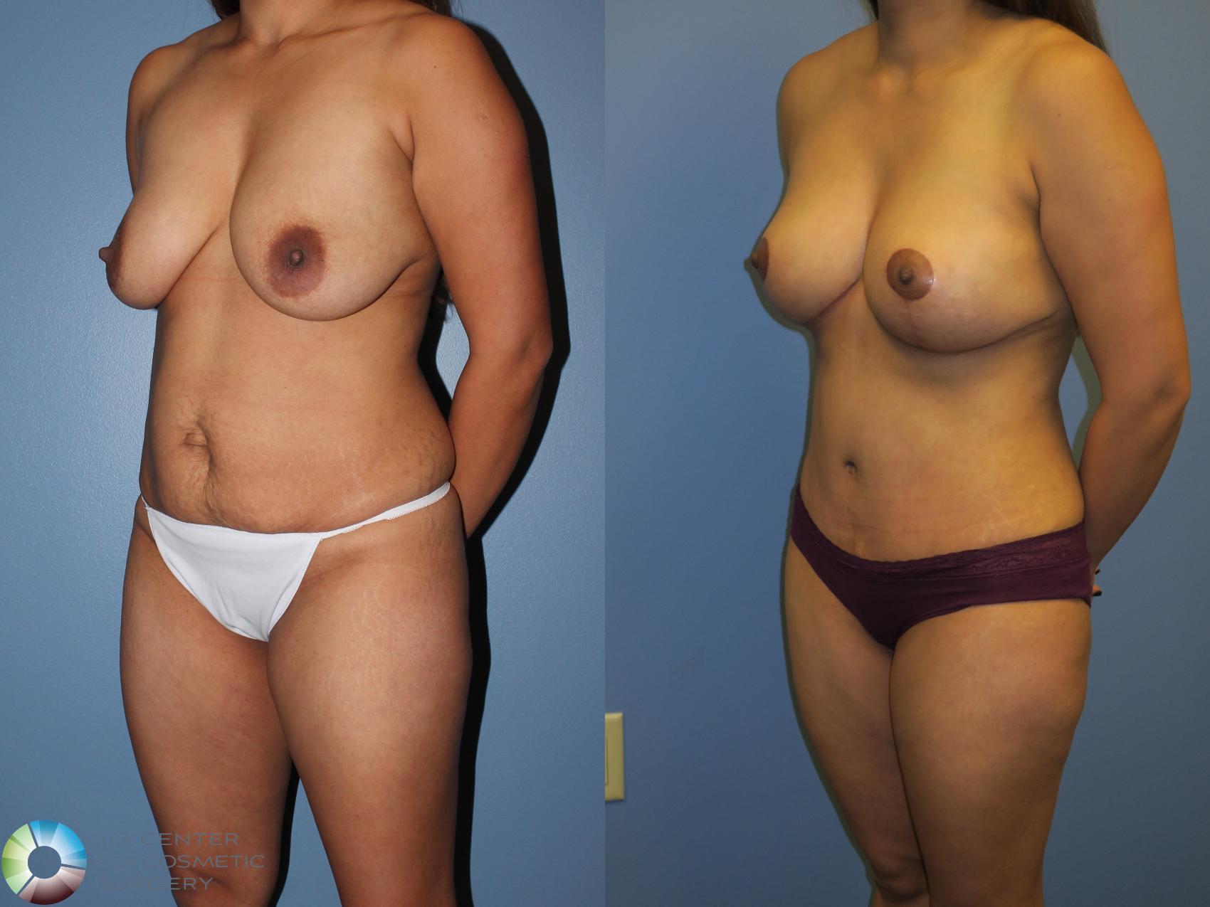 Before & After Mommy Makeover Case 11377 Left Oblique View in Golden, CO