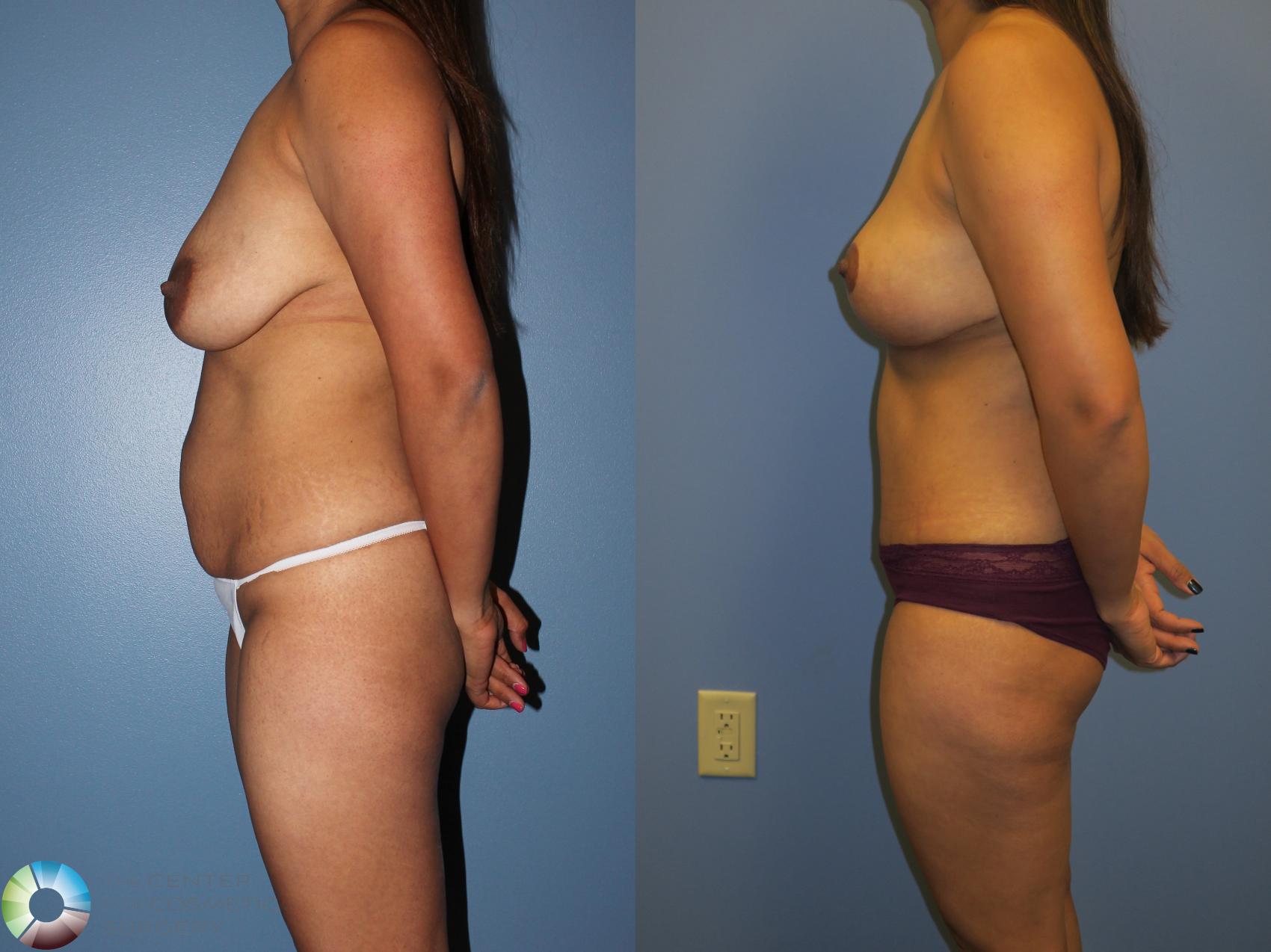Before & After Mommy Makeover Case 11377 Left Side View in Golden, CO