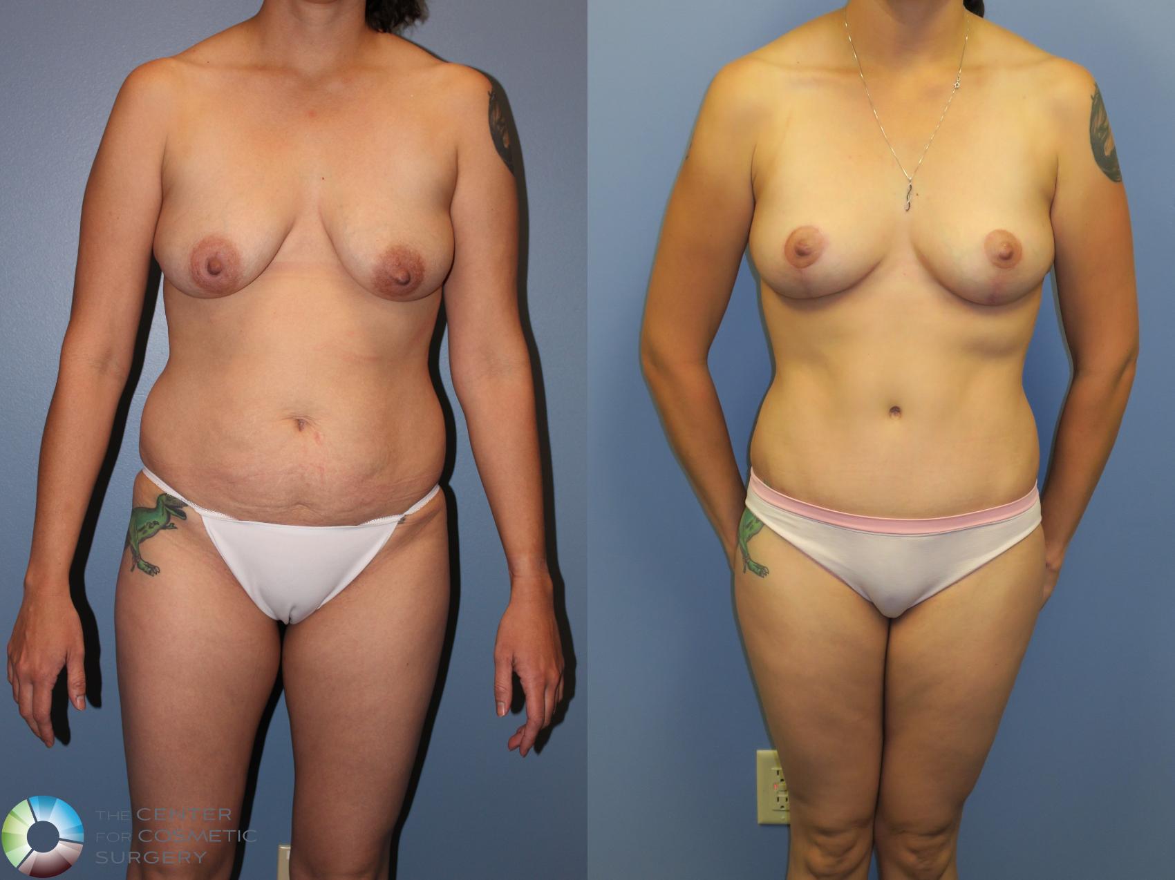 Before & After Breast Lift Case 11379 Front in Denver and Colorado Springs, CO