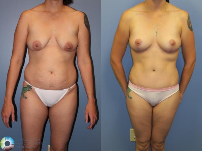 Before & After Breast Lift Case 11379 Front View in Golden, CO
