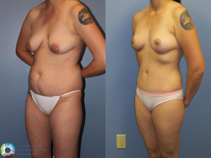 Before & After Breast Lift Case 11379 Left Oblique View in Golden, CO