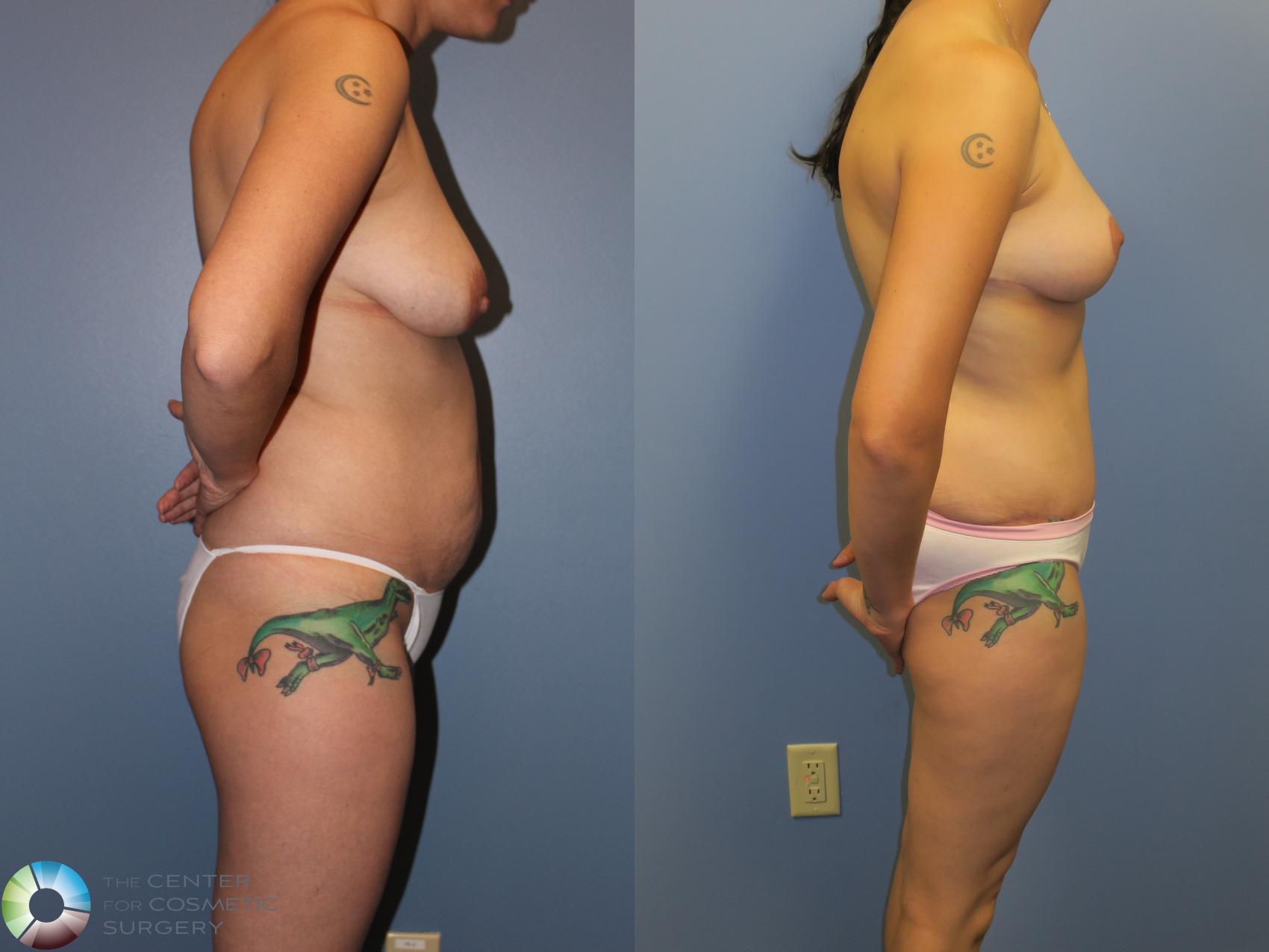 Before & After Mommy Makeover Case 11379 Right Side in Denver and Colorado Springs, CO