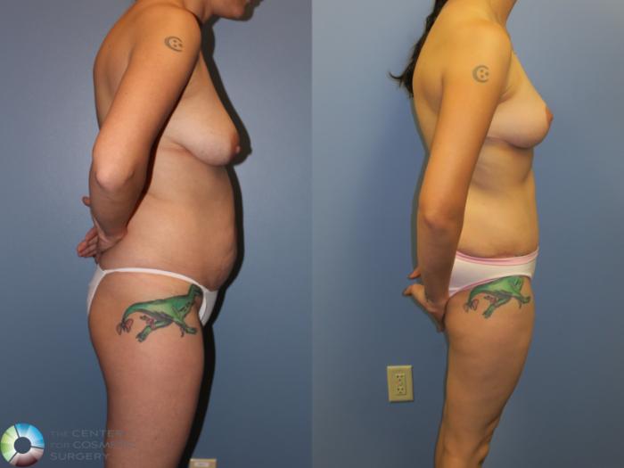 Before & After Mommy Makeover Case 11379 Right Side View in Golden, CO