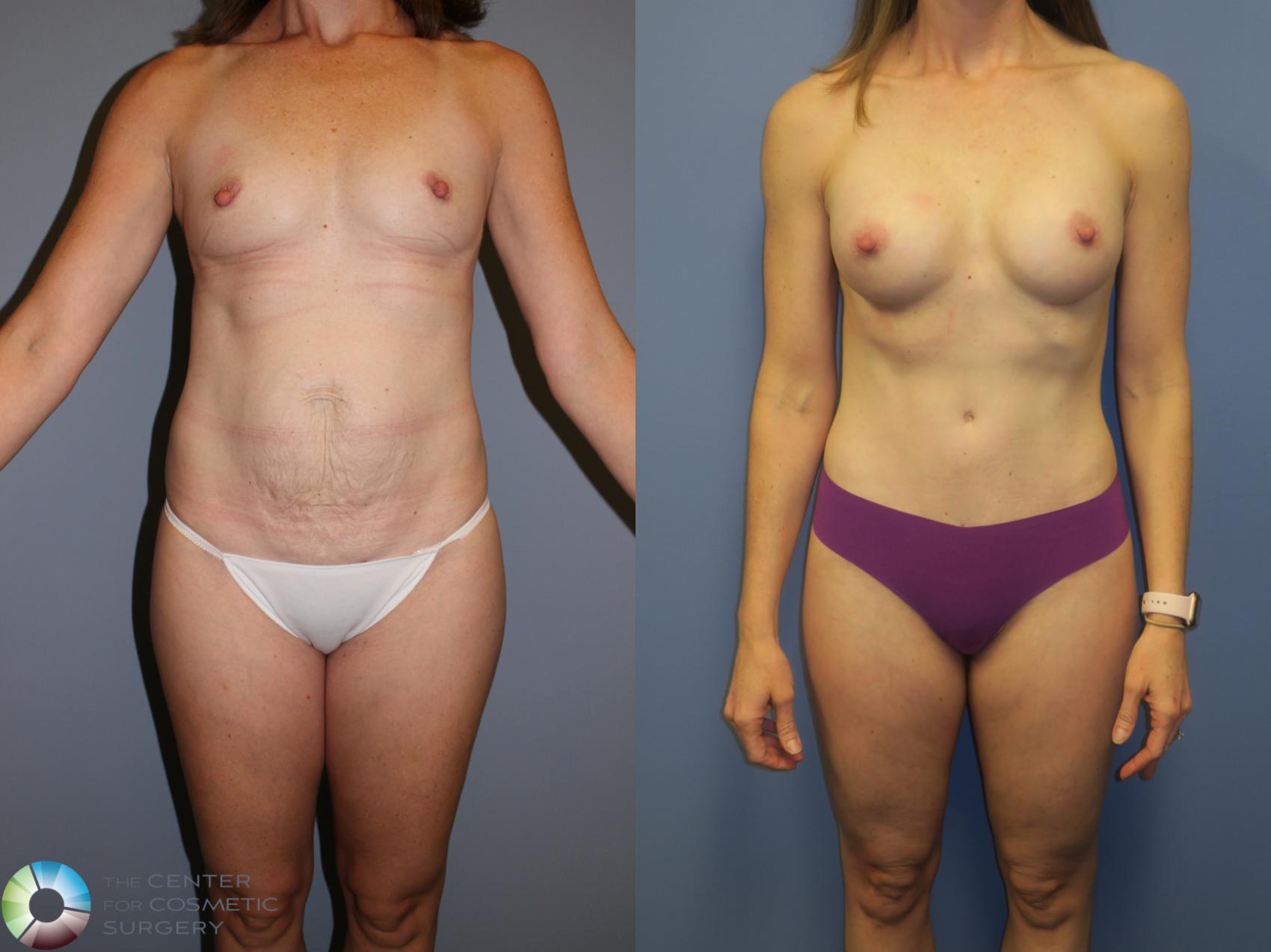 Before & After Breast Augmentation Case 11380 Front in Denver and Colorado Springs, CO