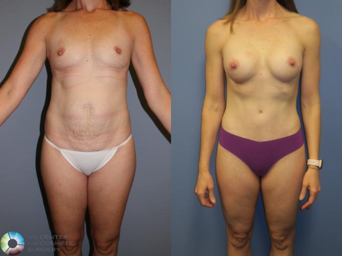 Before & After Tummy Tuck Case 11380 Front View in Golden, CO