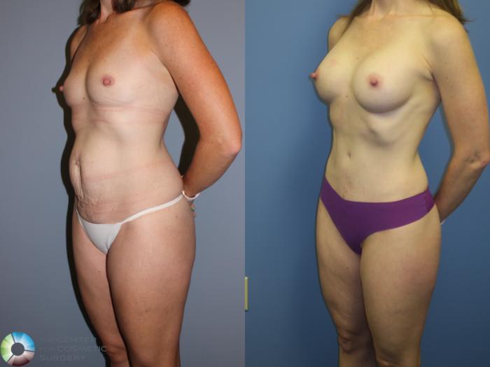 Before & After Mommy Makeover Case 11380 Left Oblique View in Golden, CO