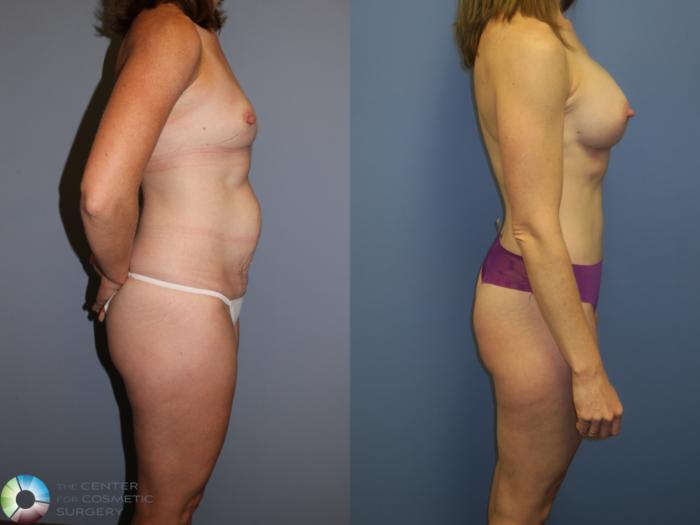 Before & After Mommy Makeover Case 11380 Right Side View in Golden, CO
