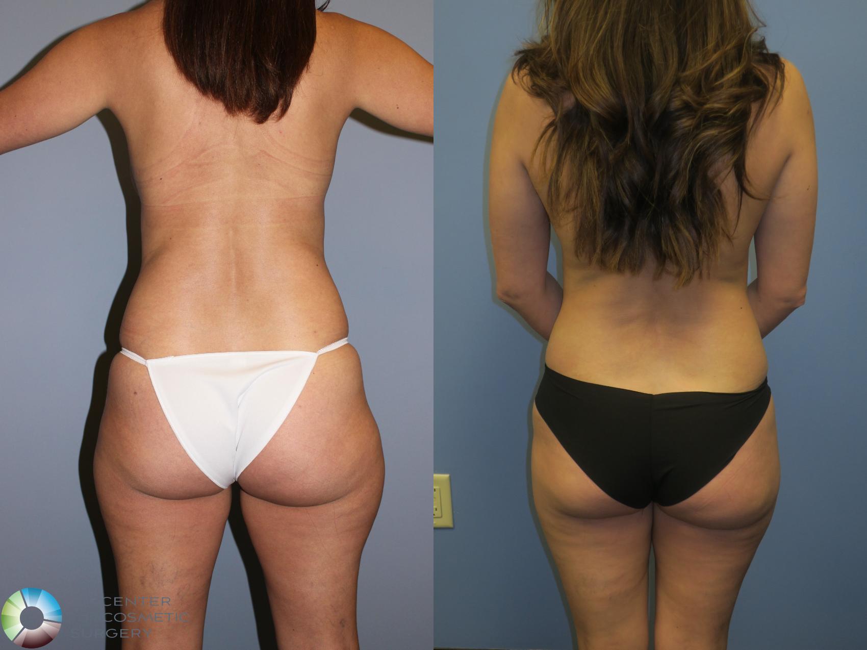 Before & After Mommy Makeover Case 11385 Back View in Golden, CO
