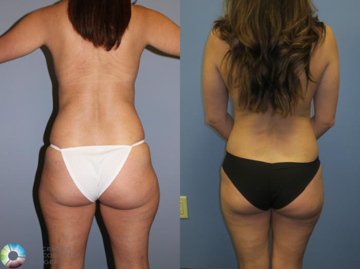 Before & After Tummy Tuck Case 11385 Back View in Golden, CO