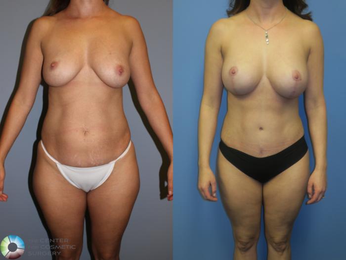 Before & After Tummy Tuck Case 11385 Front View in Golden, CO