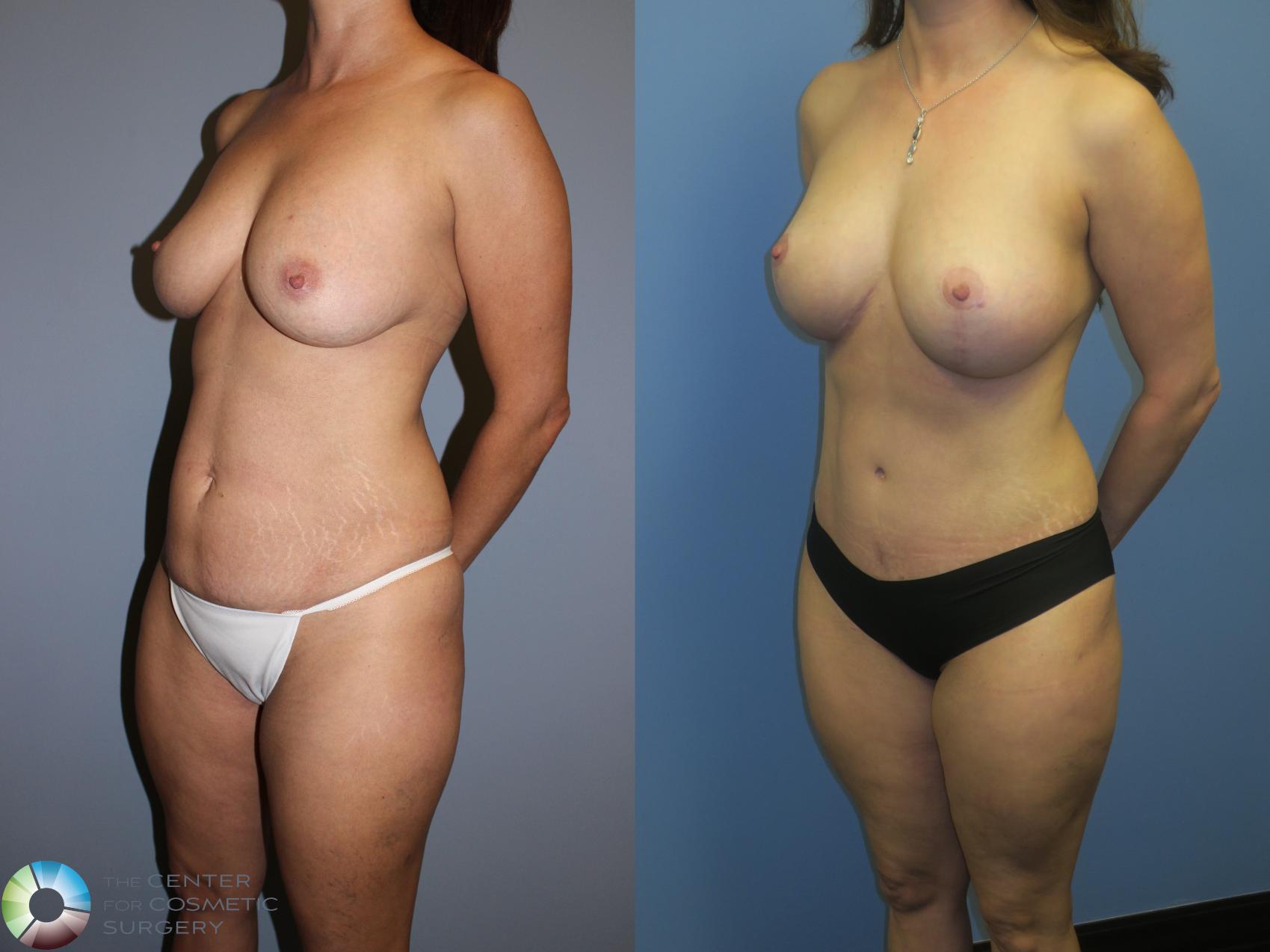 Before & After Mommy Makeover Case 11385 Left Oblique View in Golden, CO