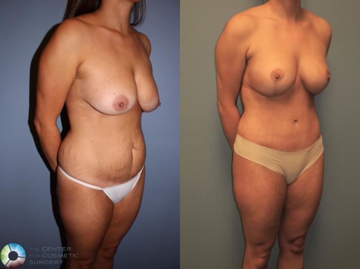 Before & After Mommy Makeover Case 11386 Right Oblique View in Golden, CO
