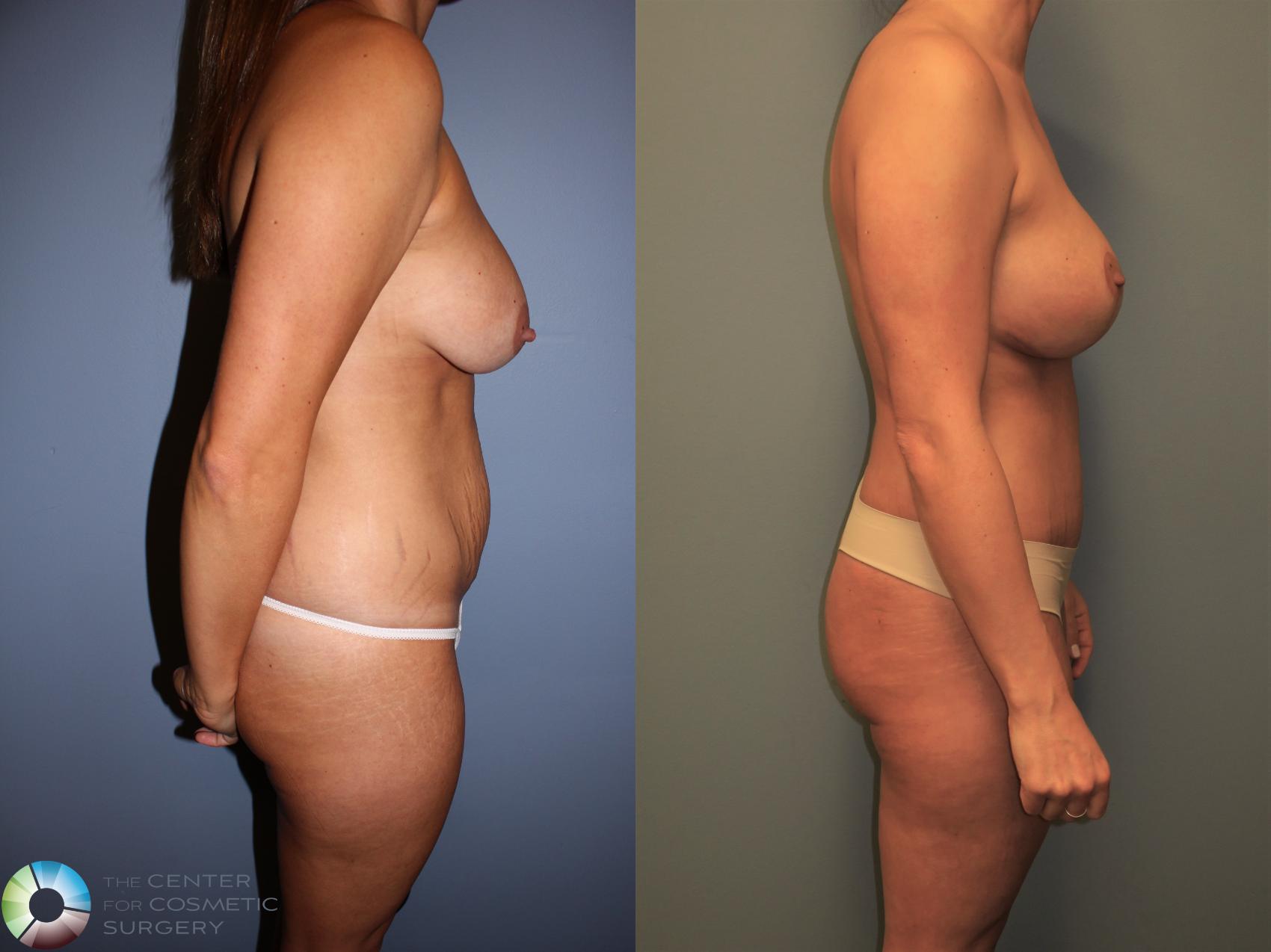 Before & After Mommy Makeover Case 11386 Right Side in Denver and Colorado Springs, CO