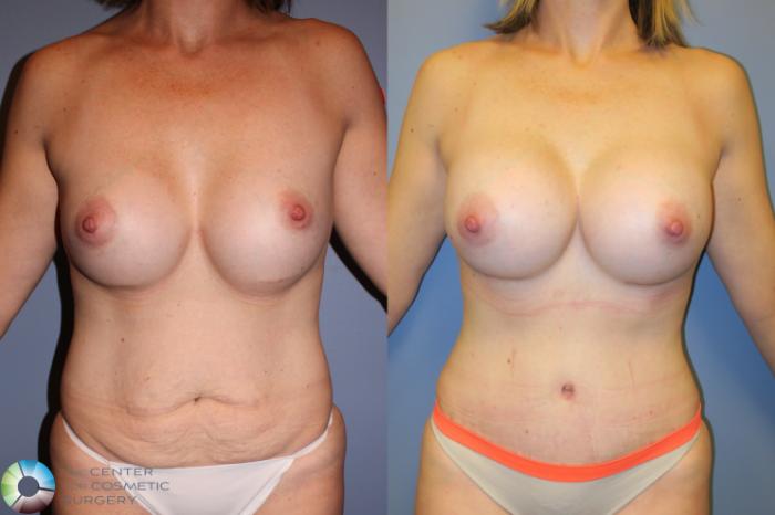 Before & After Mommy Makeover Case 11388 Front in Denver and Colorado Springs, CO
