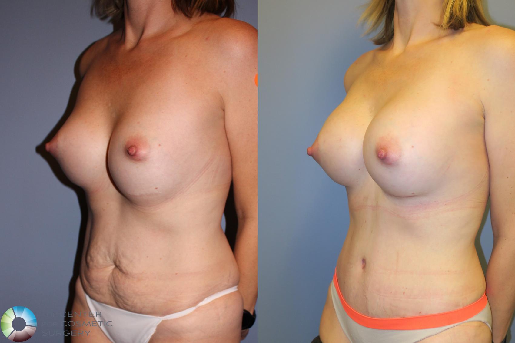 Before & After Mommy Makeover Case 11388 Left Oblique in Denver and Colorado Springs, CO