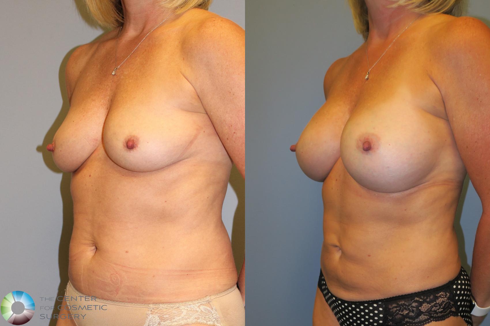 Before & After Mommy Makeover Case 11389 Left Oblique in Denver, CO