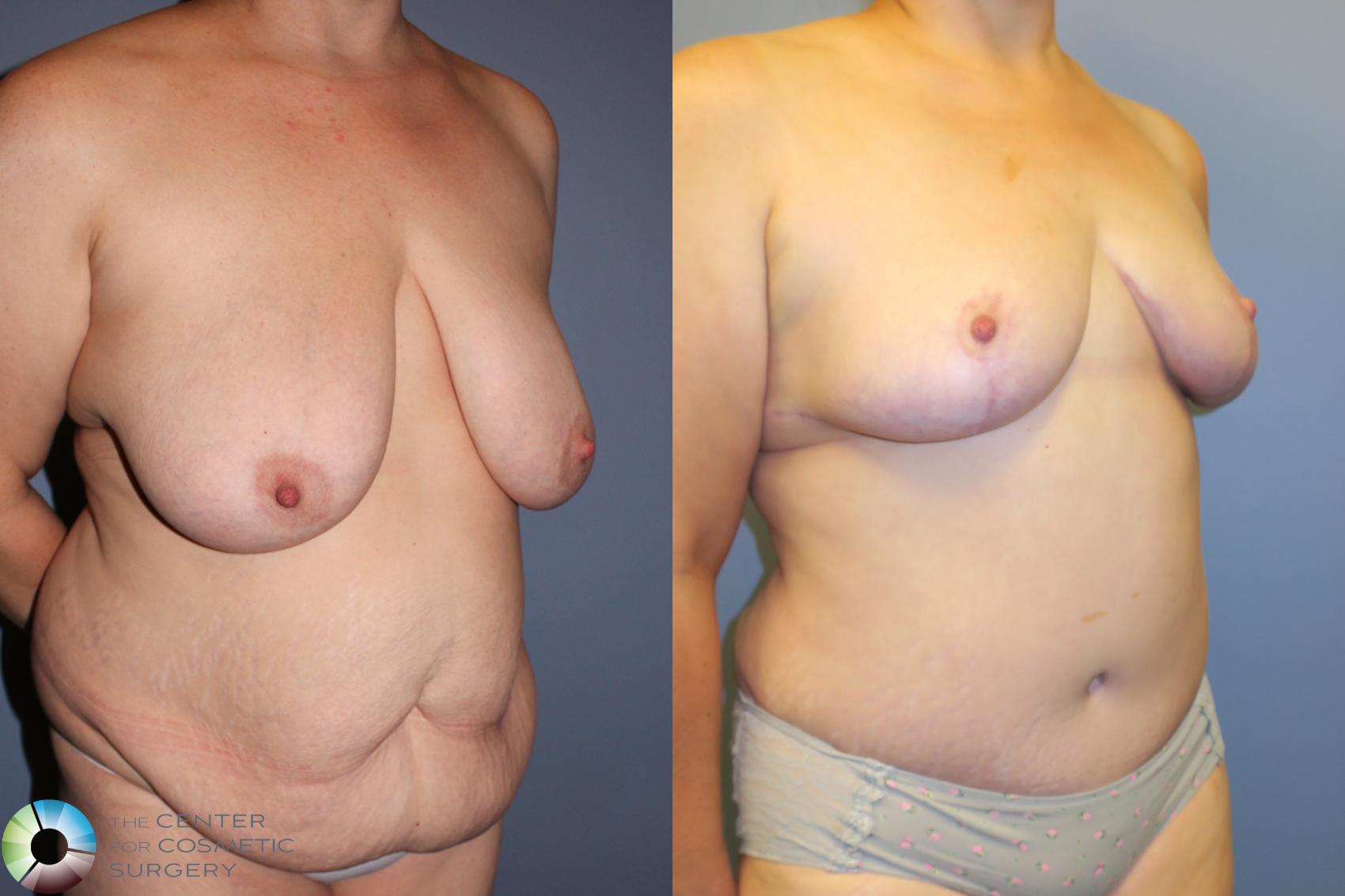 Before & After Mommy Makeover Case 11464 Right Oblique in Denver and Colorado Springs, CO